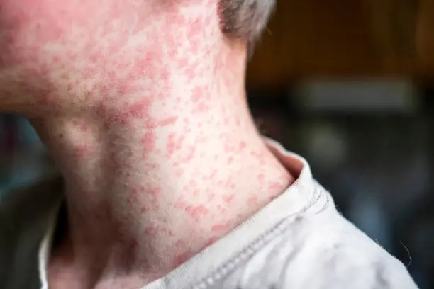 Measles Outbreaks Surge Worldwide: Families Urged to Check Vaccinations Ahead of Summer Travel